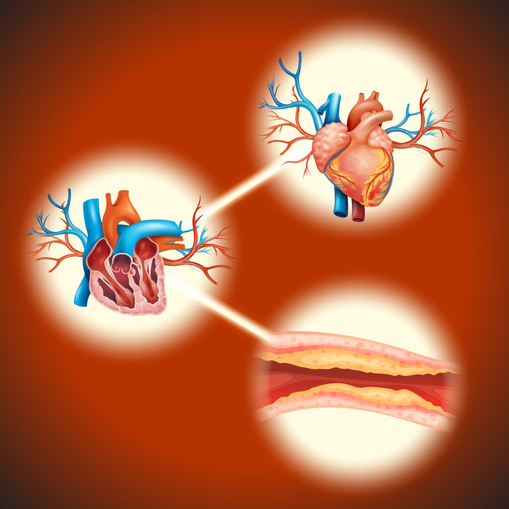 Bradycardia